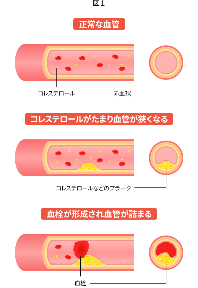 図１ 正常な血管イメージ コレステロールがたまり血管が狭くなるイメージ 血栓が形成され血管が詰まるイメージ