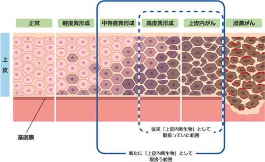 上皮 内 新 生物 と は